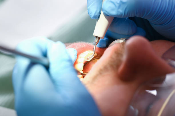 Best Emergency Broken Tooth Repair in Montesano, WA